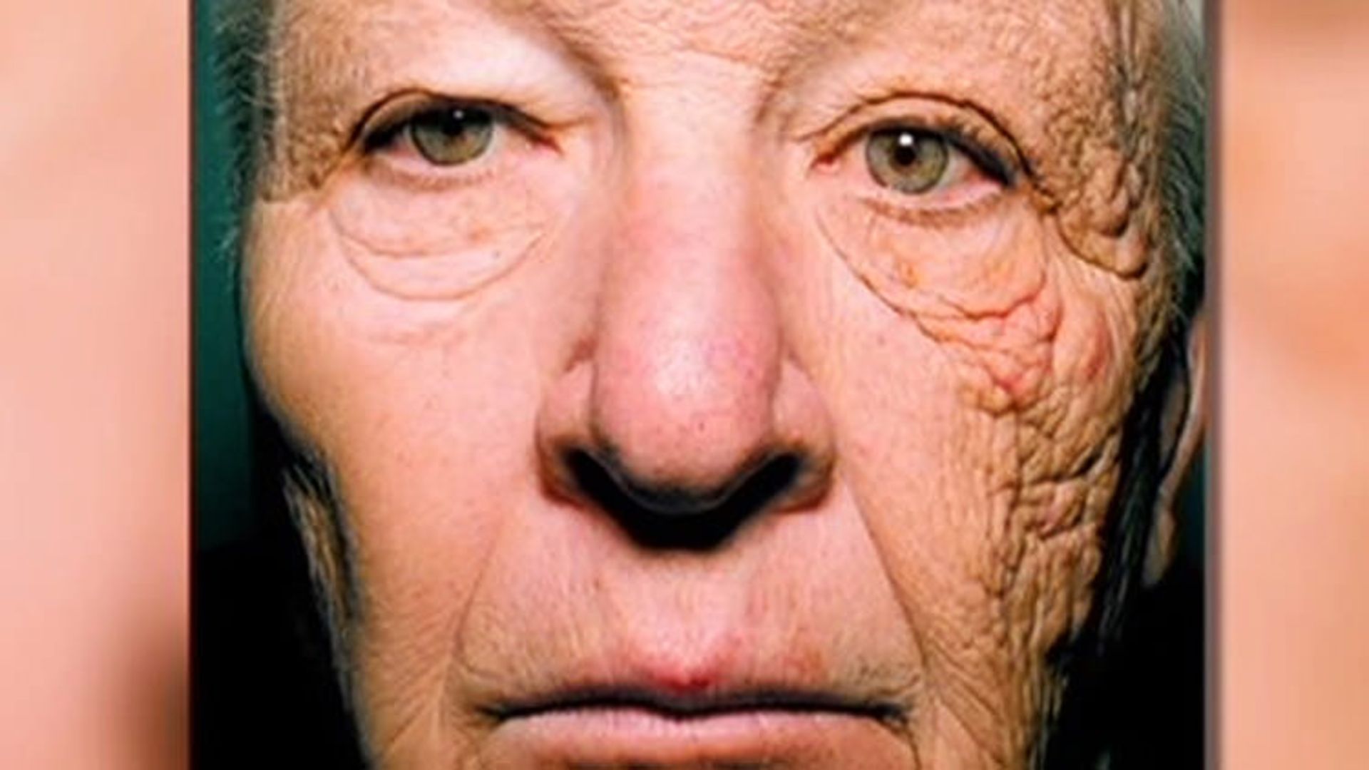 pre-aging