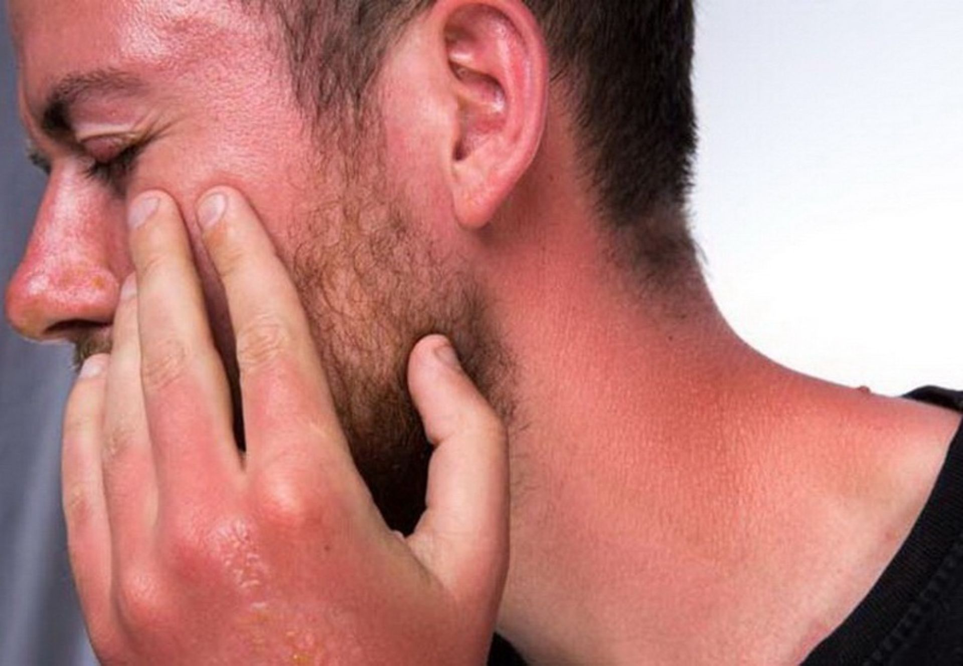 آفتاب سوختگی صورت در سفر