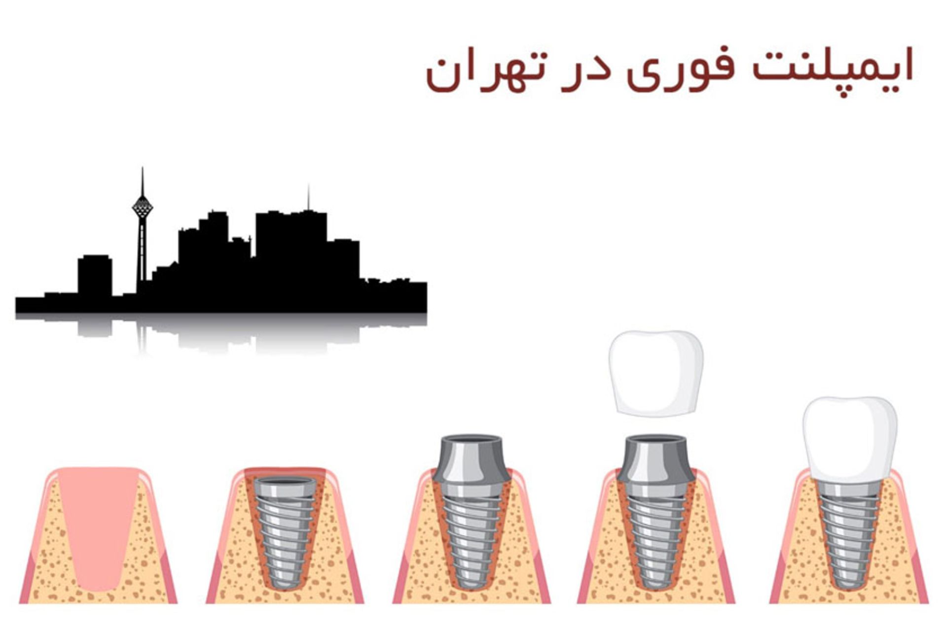 ایمپلنت فوری در تهران