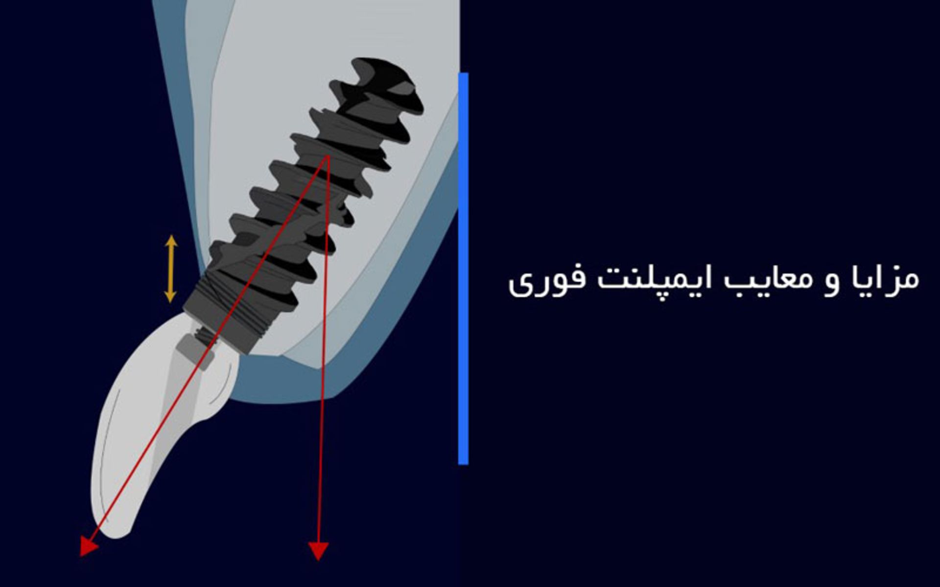 مزایا و معایب ایمپلنت