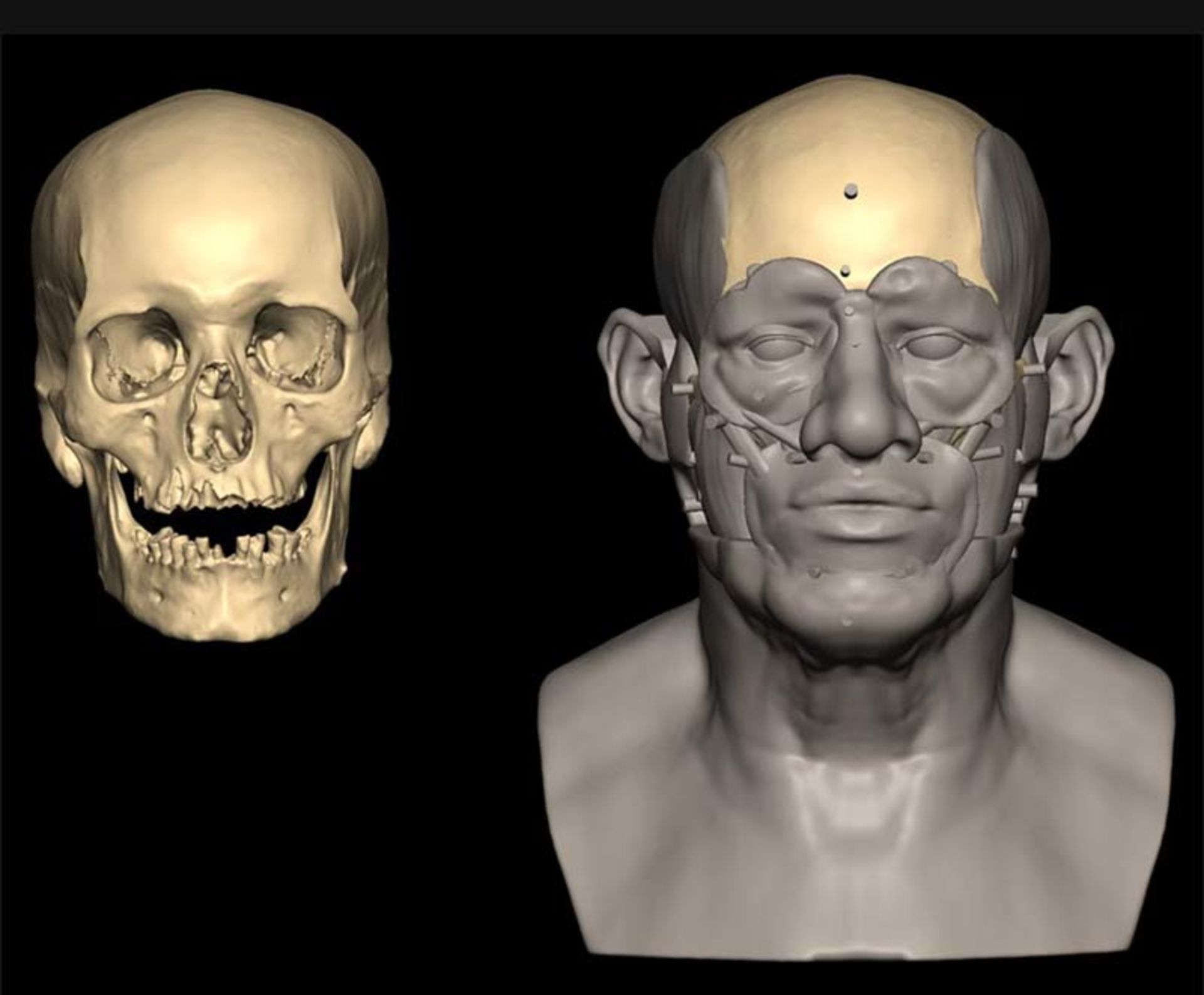 تصویر جمجمه و مراحل بازسازی چهره روی آن