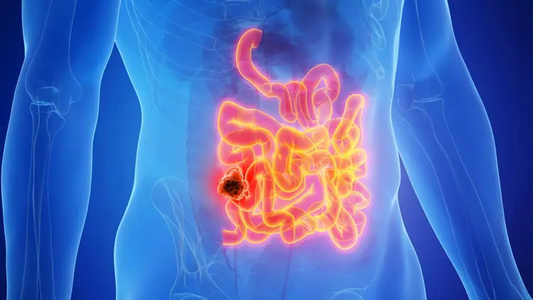 تومور در بخش مشخصی از روده بزرگ (Colon) در بدن انسان