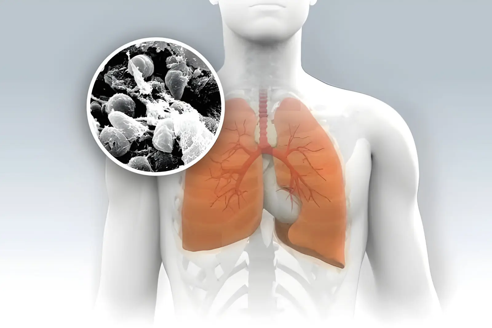 باکتری طاعون ریوی (Yersinia pestis) و ریه‌های انسان در یک مدل آناتومیک
